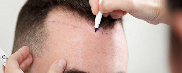 chirurgie capillaire