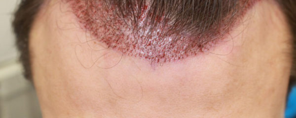 micro-greffes de cheveux